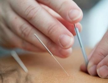 beneficios de la acupuntura en los nios